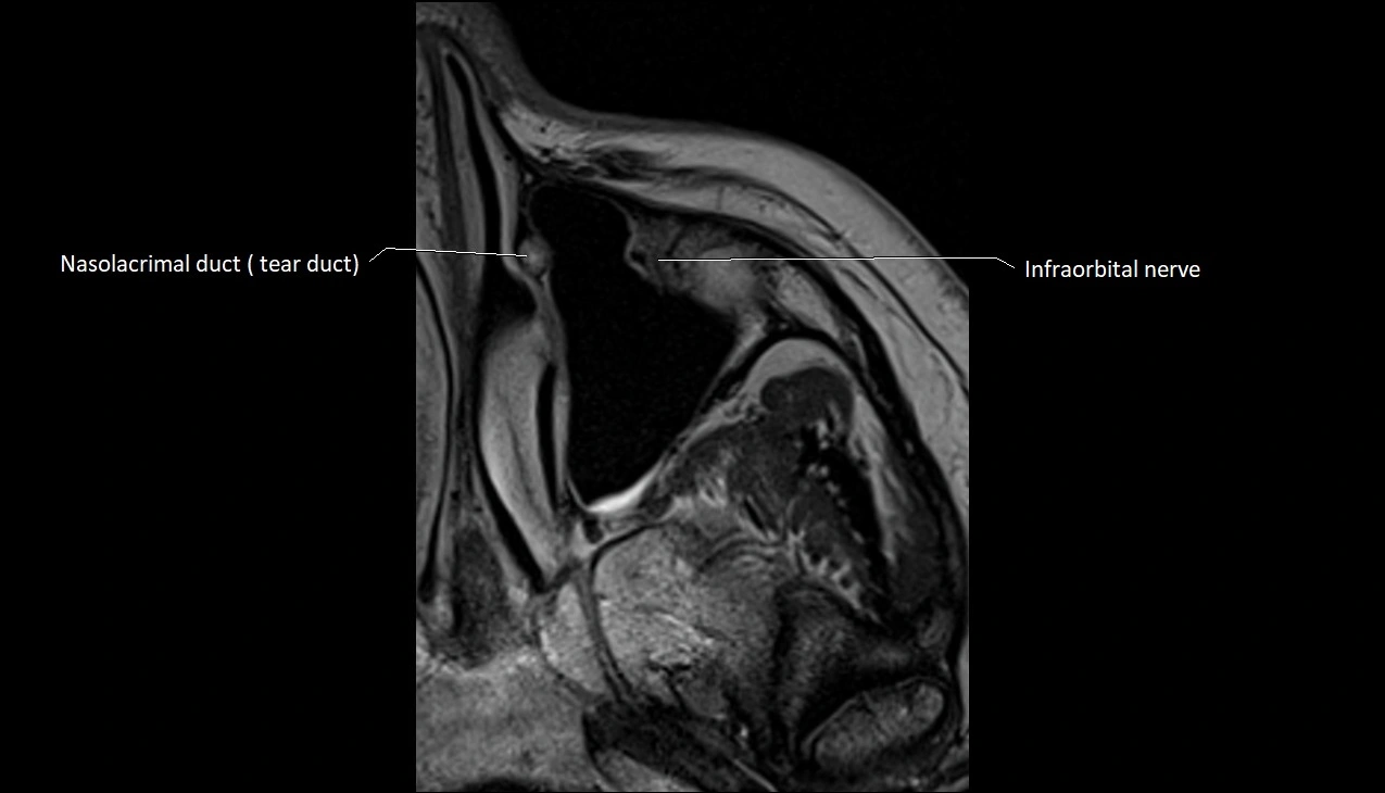 MRI Orbit axial cross sectional anatomy image 1.webp